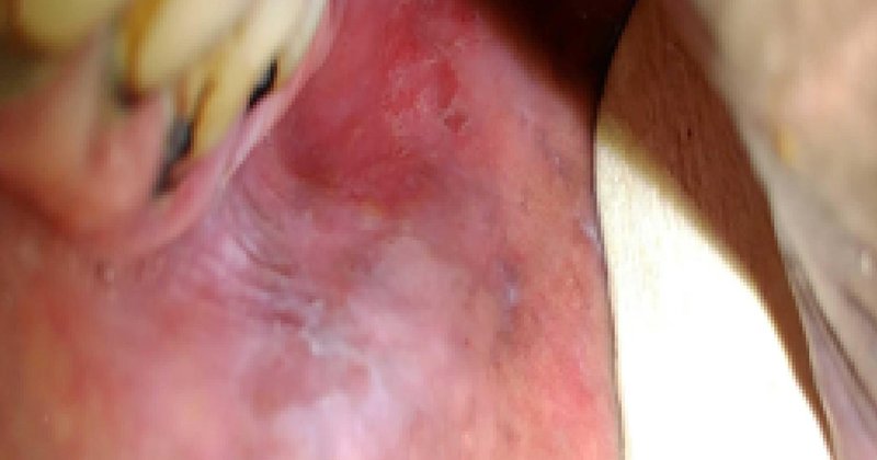 IA leve para triagem de câncer oral em smartphones alcança 87,4% de sensibilidade