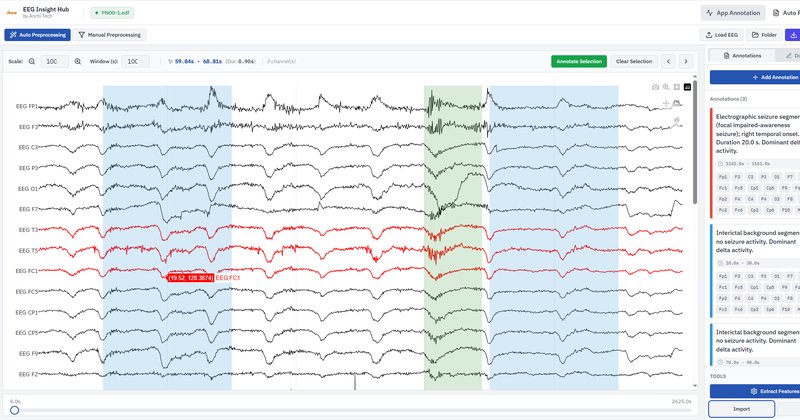 EEG-to-Report: framework para IA treinar com laudos de EEG clínico